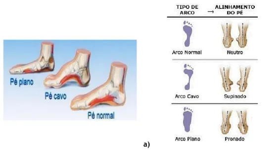 Figura 2.14 – a) Deformidades plantares: pé cavo, plano e normal. b) Tipo de alinhamento do pé [40]
