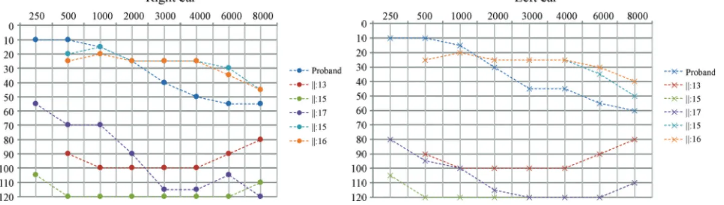 Figure 2 - Tonal audiometry showing thresholds for six affected individuals.