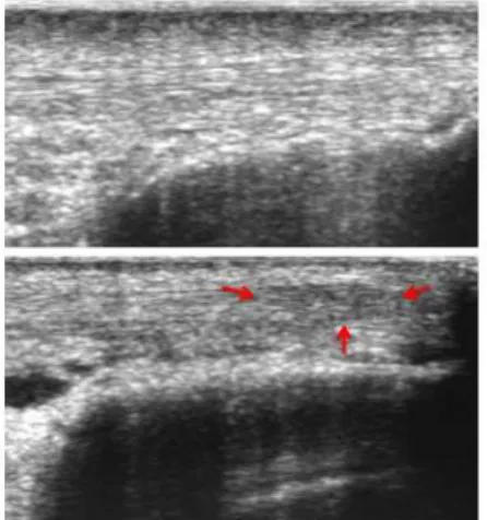 FIGURA 9: Imagens de ultrassonografia de tendão patelar sem anormalidades (acima)  e com anormalidades (abaixo)