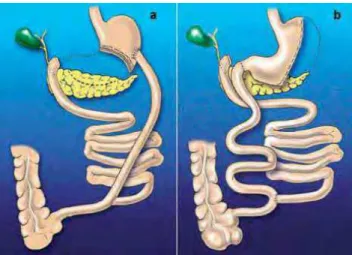 Figura 2. Esquema de técnicas bariátricas de derivação biliopancreática: a) derivação  biliopancreática de Scopinaro; b) derivação duodenal Switch.(ASBS: American Society  for Bariatric Surgery)