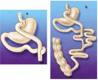 Figura 3. Esquemas cirúrgicos de bypass gastrointestinal: a) asa de Y de Roux corta; 