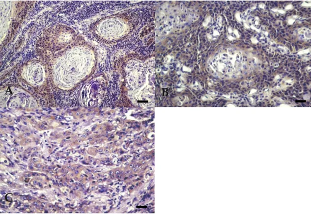 Figure 5. Expression of profilaggrin in BOSCC. (A) WD: granular cytoplasmatic and intense reaction,  observed in all cellular types, including basal-like cells