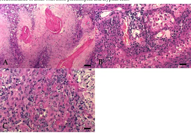 Figure 1. Bovine Ocular Squamous Cell Carcinoma. (A) WD: extensive keratin pearl formation
