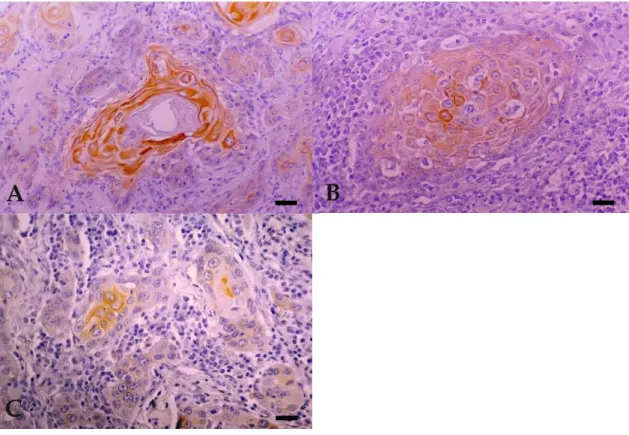 Figure 3. Expression of cytokeratin marker LP34 in BOSCC. (A) WD: cytoplasmic diffuse and intense  immunoreactivity, seen mostly in well-differentiated tumour cells but also in dysqueratotic and  acantolytic cells