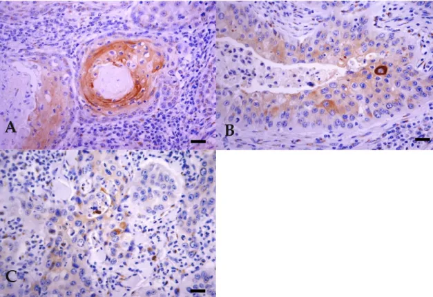 Figure 4. Expression of involucrin in BOSCC. (A)  WD: cytoplasmic diffuse and intense  immunoreactivity, seen mostly in well-differentiated tumour cells