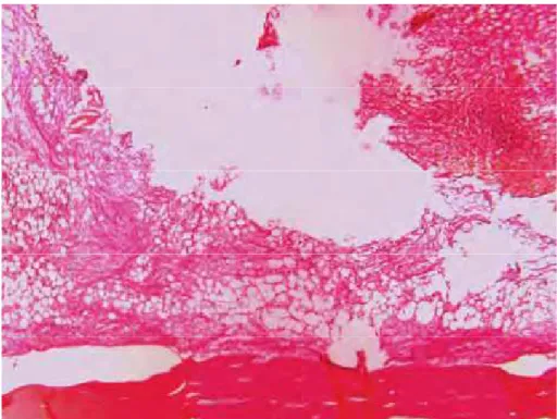 Fig. 26: Aspecto da interface no grupo controle. Tecido ósseo apenas na cortical inferior e  tecido imaturo preenchendo a interface