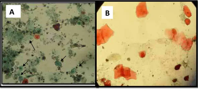 FIGURA 8 -   A)  Lâmina corada pelo método de Hematoxilina - Shorr  pertencente ao Grupo II (Cesariana),  em  aumento de 400  vezes/campo, evidenciando maior quantidade de células  cianofílicas (verde- azuladas),com relação às células  orangeofílicas