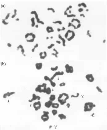 Table 1 - Karyotype abnormalities detected in 65 infertile men.