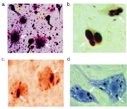 Figure 1. Examples of protein aggregates identified in distinct neurodegenerative diseases