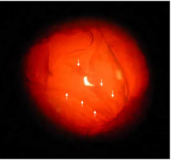 Figura 2: Imagem fotográfica, por retroiluminação, de LIO implantada no saco  capsular de um coelho: observar o aspecto de pregas, rugas lineares no disco óptico  da LIO (setas) da OCP fibrosa