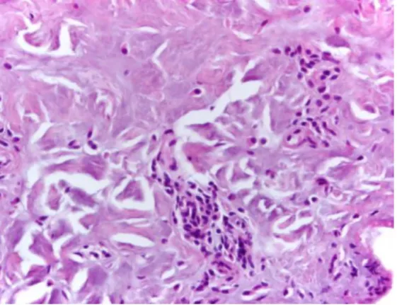 Figura 15 - Pele após o escaldão, canais na derme  rodeados de eosinófilos, 400x (Foto original).