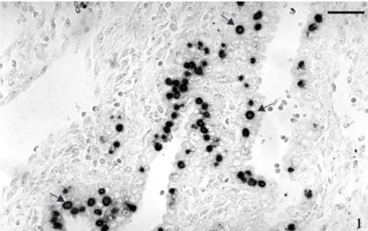 Figure 1. False positive staining of cell nuclei in the glandular epithelium of decidua, obtained from abortion case