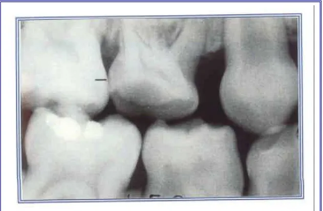 FIGURA 14 -  Imagem radiográfica da radiolucidez   na metade interna do esmalte (Escore 2)