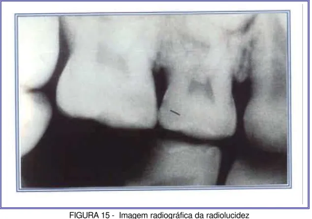 FIGURA 16 - Imagem radiográfica da radiolucidez   nos dois terços externos da  dentina (Escore 4)