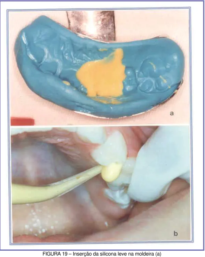 FIGURA 19 – Inserção da silicona leve na moldeira (a)   e no espaço interdental com seringa apropriada (b)