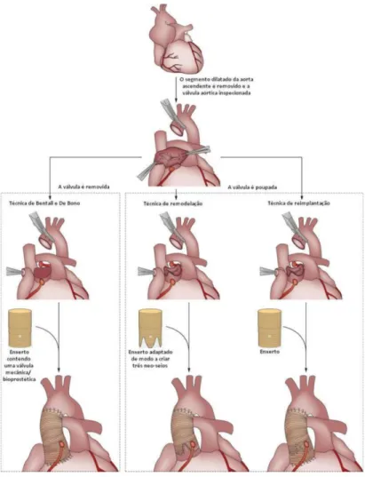 Figura 6 Técnicas cirúrgicas profilácticas usadas nos doentes com Síndrome Marfan, Sindrome Loeys- Loeys-Dietz e Sindrome  Shprintzen-Goldberg
