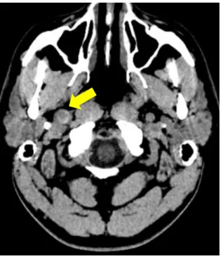 Figura 5: Caso nº 10. Imagens diagnósticas de doente do sexo masculino, com 42 anos  que recorre ao SU com queixa de cefaleias