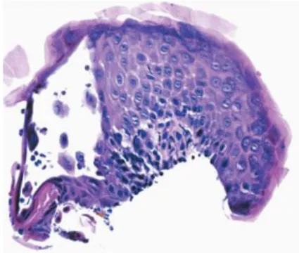 Figure  15.  Feline  PF.  Large  subcorneal  pustule  with  neutrophils  and  acantholytic  keratynocytes