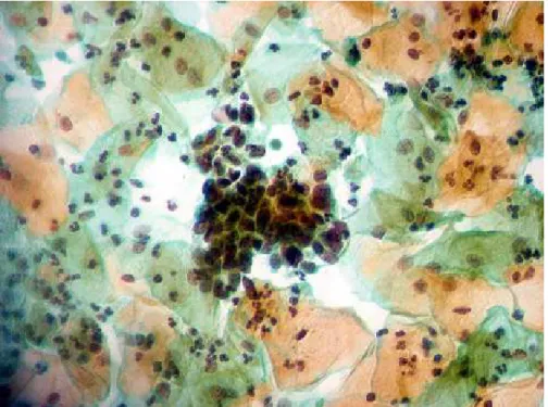 FIGURA 10 - Fotomicrografia de esfregaço cervical apresentando um grupamento  de células escamosas atípicas, compatível com LAG