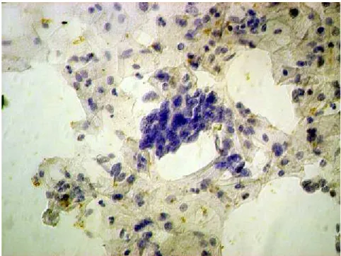 FIGURA  11  -  Fotomicrografia  de  esfregaço  cervical  apresentando  imunorreatividade  negativa  para  p16 INK4A   em  grupamento  de  células  com  alteração compatível com LAG, 400X