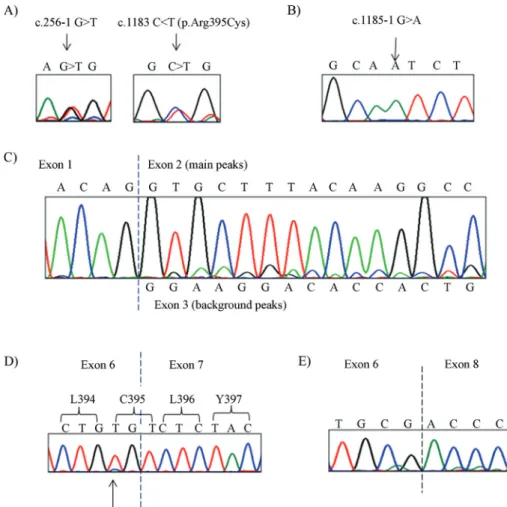 Figure 1 - Genomic and cDNA sequences showing case 1 and case 2 mutations. A) Case 1 genomic sequence showing heterozygote mutations