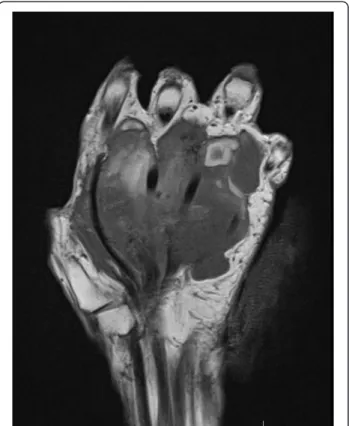 Figure 1 Palmar aspect of the left hand showing a large nodular mass over the first four rays.