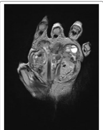Figure 10 Magnetic resonance imaging scan of the hand showing tumor recurrence with a large hypervascular mass and foci of necrosis that occupied most of the anterior