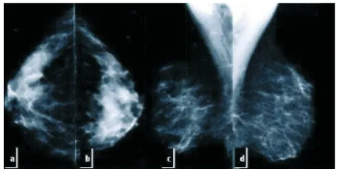 Figura 2 - Imagens de mamografia: a) Mama direita  em projeção CC; b)Mama esquerda em projeção CC; 