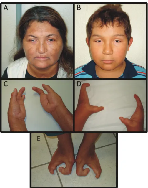 Figure 2 - Images showing split-hand/foot malformation (SHFM) in patients investigated