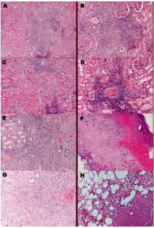 Fig. 2 Fig. 2 A Fig. 2 B Fig. 2 C Fig. 2 D Fig. 2 E Fig. 2 F Fig. 2 G Fig. 2 H– Histopathology:: HE (4x10): lower pole of left kidney – dilated and atrophicremnant tubules (A), some of it containing eosinophilic proteinaceous material (B)