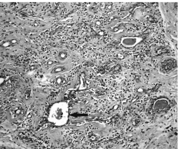 Figure 1. Udder. Goat infected by M. agalactiae. There is severe infiltration by mononuclear cells and neutrophils in the interstitial tissue