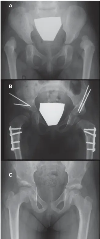 Figura 12. A) DDA grau IV bilateral, em que as cabeças  femorais estão acima da linha horizontal que passa  no rebordo acetabular