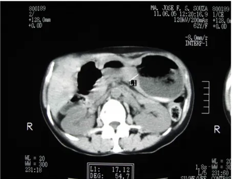FIGURA  04-  Mensuração  tomográfica  do  ponto  de  maior  espessura  do  tumor gástrico em milímetros