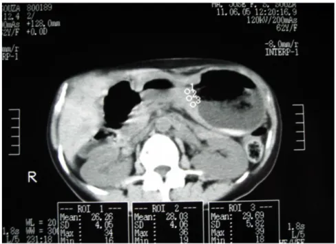 FIGURA  06-  Mensuração  tomográfica  da  atenuação  (em  unidades  de  Houndsfield) em três diferentes pontos do tumor (duas extremidades e centro)  após a administração endovenosa do contraste iodado
