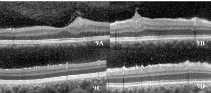 Figura 9. A) SD-OCT do OD mostrando hamartoma de retina confinado às camadas de  células ganglionares e CFNR; Trata-se de tumor hiperrefletivo, translucente que permite  a visualização das camadas externas da retina