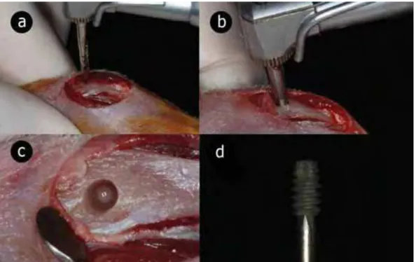 FIGURA 5 – Perfuração com fresa lança (a) e espiral 1,8 mm (b) sob  constante irrigação para criar o leito ósseo (c) para inserção do implante  (d)
