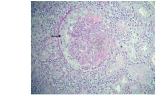 Figure 3. Cellular crescent (arrow) associated with endocapillary proliferation (PAS, x400).