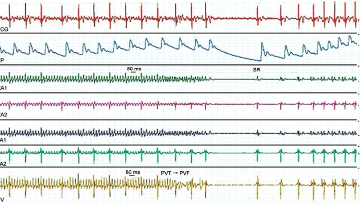 Figure 5. Example of a recording with pulmonary vein tachycardia (PVT) induced by stimulation of the pulmonary veins (50 Hz, 10 s) combined with vagal activation, showing the transition to pulmonary vein fibrillation (PVF) followed by termination of the ar