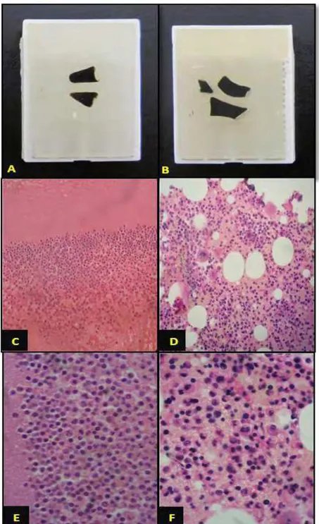 Figura 1- Ilustração de amostras de capa leucocitária e medula óssea. Aspecto  das cito inclusões de capa leucocitária (A) e medula óssea (B) à macroscopia