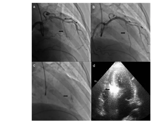 Figure 1 Procedure: (a) angiography, right oblique cranial view of the left coronary artery, showing the target vessel; (b) selective catheterization of the target vessel and placement of balloon catheter; (c) selective angiography of the target vessel, sh
