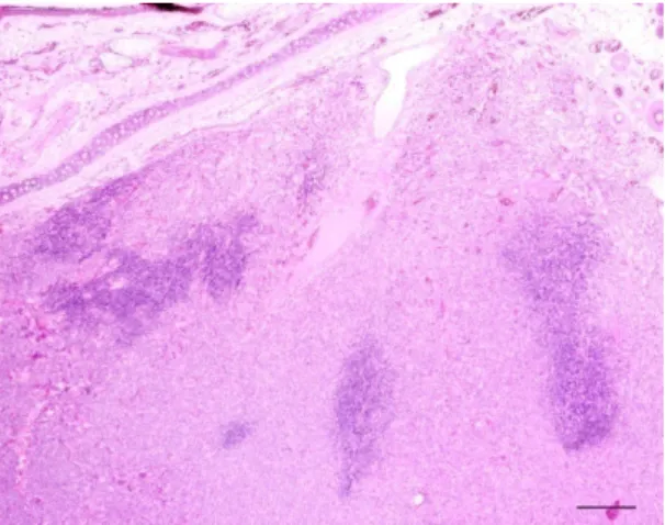 Figura 12: Histiocitoma cutâneo canino do  grupo histológico II. O infiltrado linfóide forma  folículos à periferia do tumor