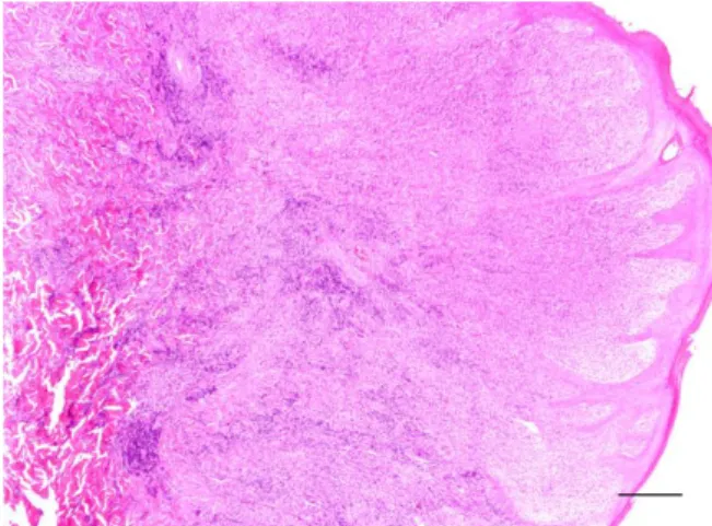 Figura 13: Histiocitoma cutâneo canino do grupo  histológico III. O infiltrado linfóide é abundante no  centro e na periferia do tumor