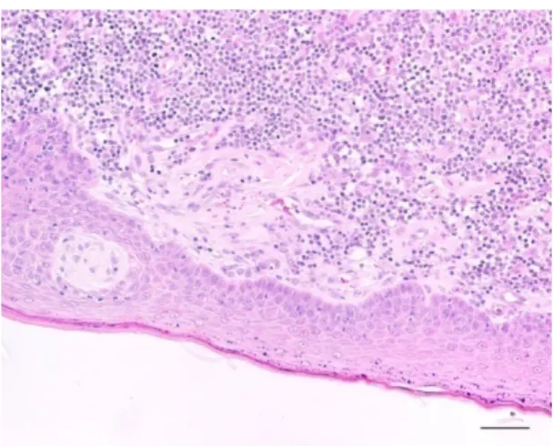 Figura 15: Histiocitoma cutâneo canino do  grupo histológico IV com marcada formação de  tecido fibroso sub-epidérmico