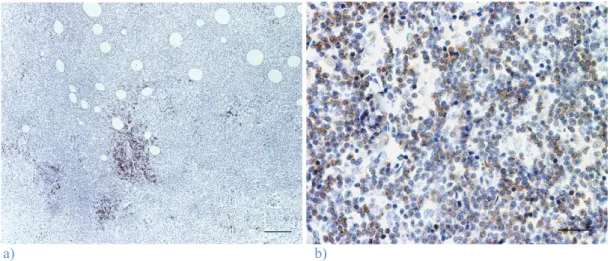 Figura 17: Imunorreactividade para o CD79 +  em linfócitos B. a) Histiocitoma cutâneo canino do  grupo II