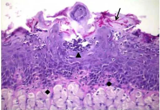 Figura 10 – Corte sagital do dorso da língua do camundongo do grupo F-L+. Observam- Observam-se  leveduras  e  hifas  (↓)  na  queratina,  microabscesso  intraepitelial  (▲)  e  células  inflamatórias na lâmina própria (♦)