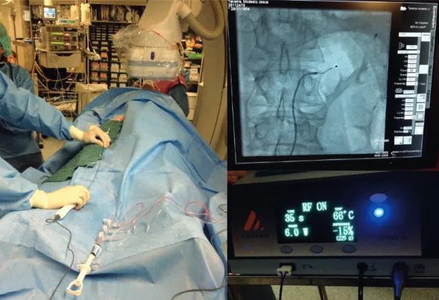 Figure 6: An overview of the cathlab setup during an RDN procedure.