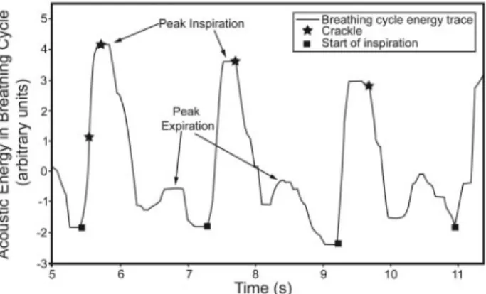 Fig. 1. The solid line show the acoustic energy due to the flow noise during the breathing cycle