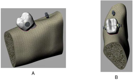 Figura 1A e 1B  – Imagem esquemática do modelo simulado, com localização do mini- mini-implante a aproximadamente 10 mm distalmente ao molar