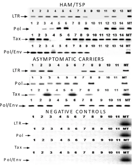 Figure  4.    Southern  blot  hybridization  of  PCR  products  obtained  from  DNA  of  five  days  old  primary  oral  keratinocytes  from  HAM/TSP and AC using different pairs of HTLV-1 oligonucleotide primers