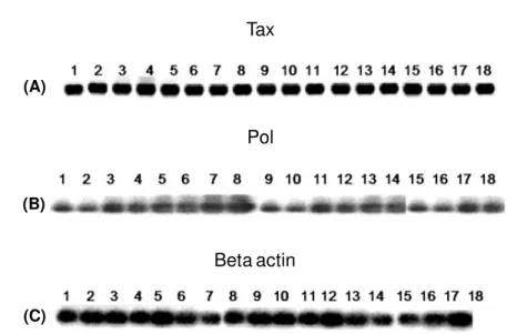 Figure 5. Southern blot hybridization from RT-PCR products of (A) Tax and (B) Pol polyA +  RNA obtained from oral epithelial  cells of those HAM/TSP patients and Healthy Carriers